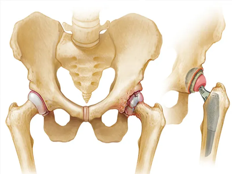 عمل جراحی تعویض مفصل لگن