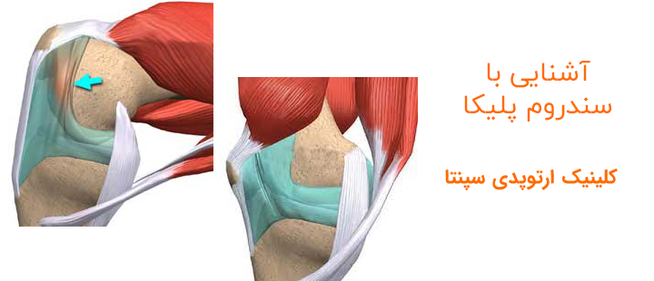 آشنایی با سندروم پلیکا