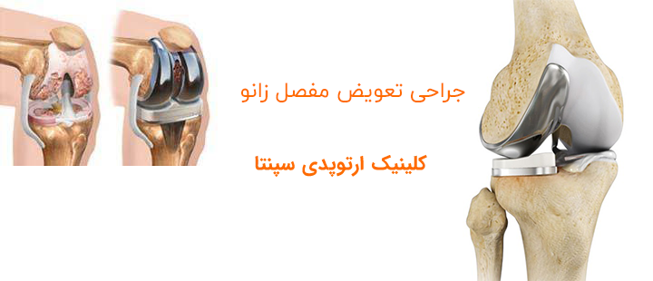 جراحی تعویض مفصل زانو چیست؟
