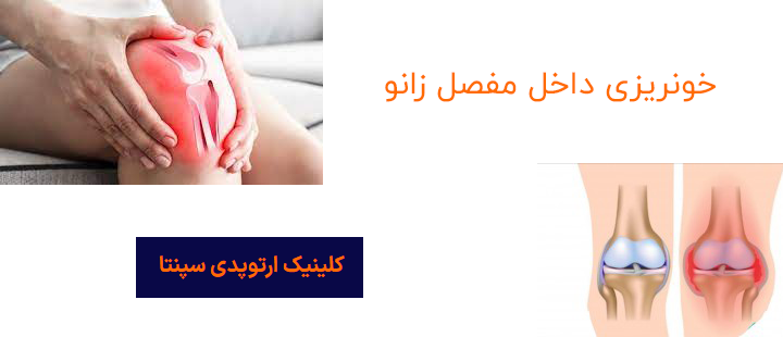 خونریزی داخل مفصل زانو