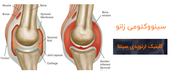 سینووکتومی زانو چیست؟
