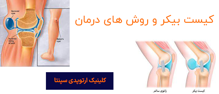 کیست بیکر و روش های درمان