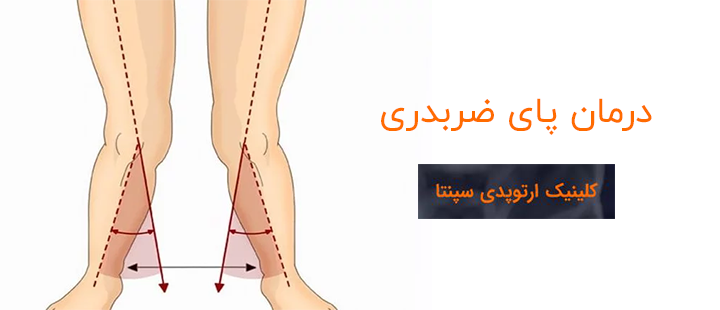 درمان پای ضربدری