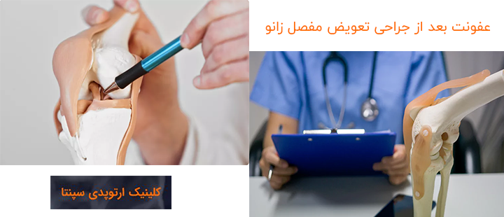 انواع عفونت بعد از جراحی تعویض مفصل زانو