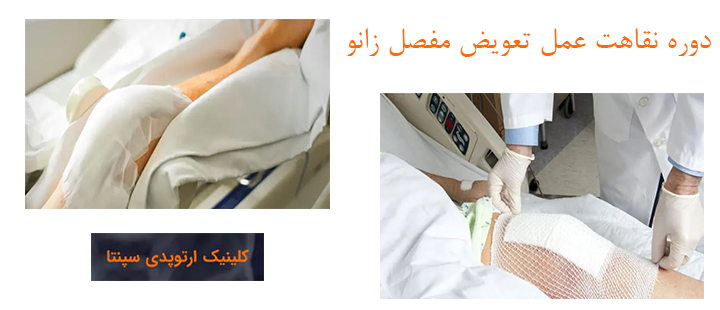 دوره نقاهت بعد از جراحی تعویض مفصل زانو