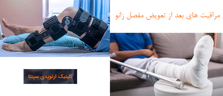 مراقبت های بعد از تعویض مفصل زانو