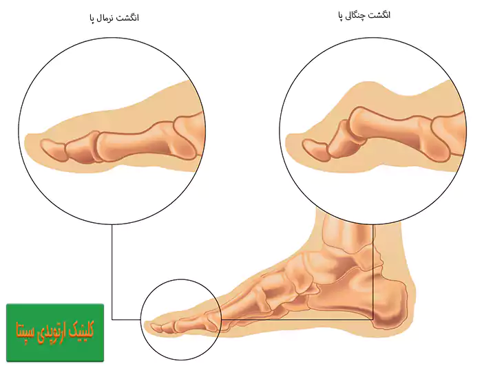 روش های درمان و پیشگیری از انگشت چنگالی پا
