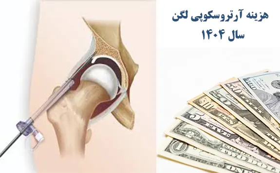 هزینه آرتروسکوپی لگن