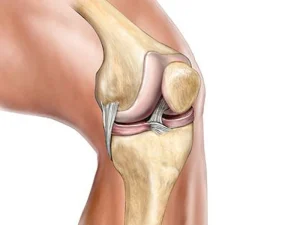 عوارض جراحی مینیسک زانو
