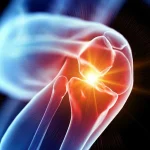 عوارض جراحی آرتروسکوپی زانو، هر آنچه باید قبل از عمل بدانید