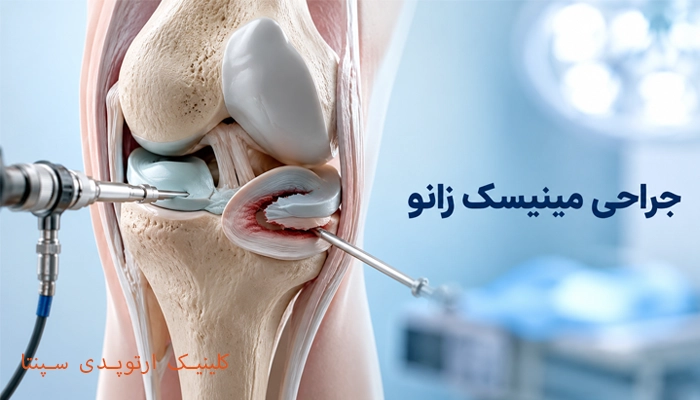 جراحی مینیسک زانو